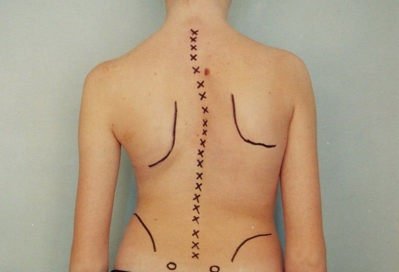 Детский сколиоз и факторы, способствующие его развитию