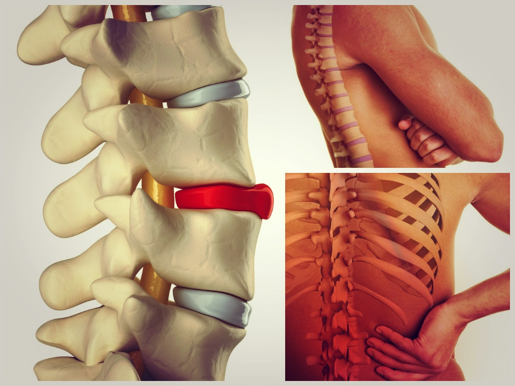 Грыжа межпозвоночного диска - симптомы, лечение