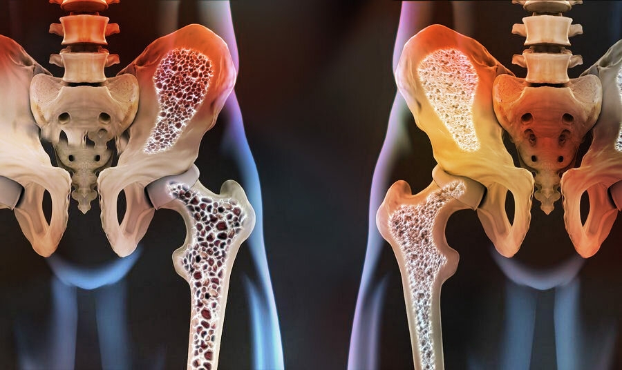 Остеопороз - симптомы болезни и лечение