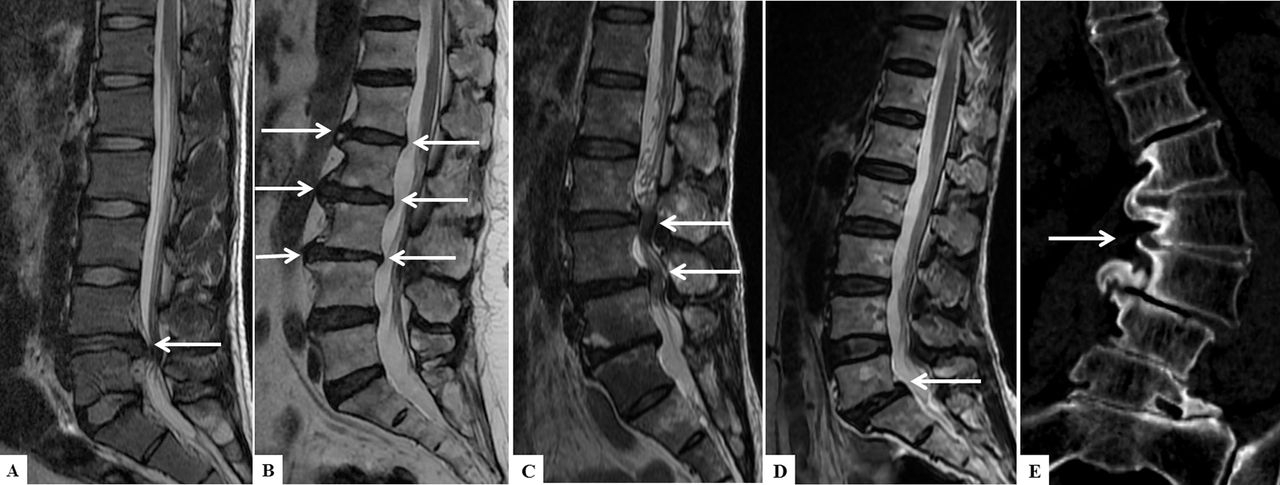 Спондилез поясничного отдела позвоночника - симптомы и лечение