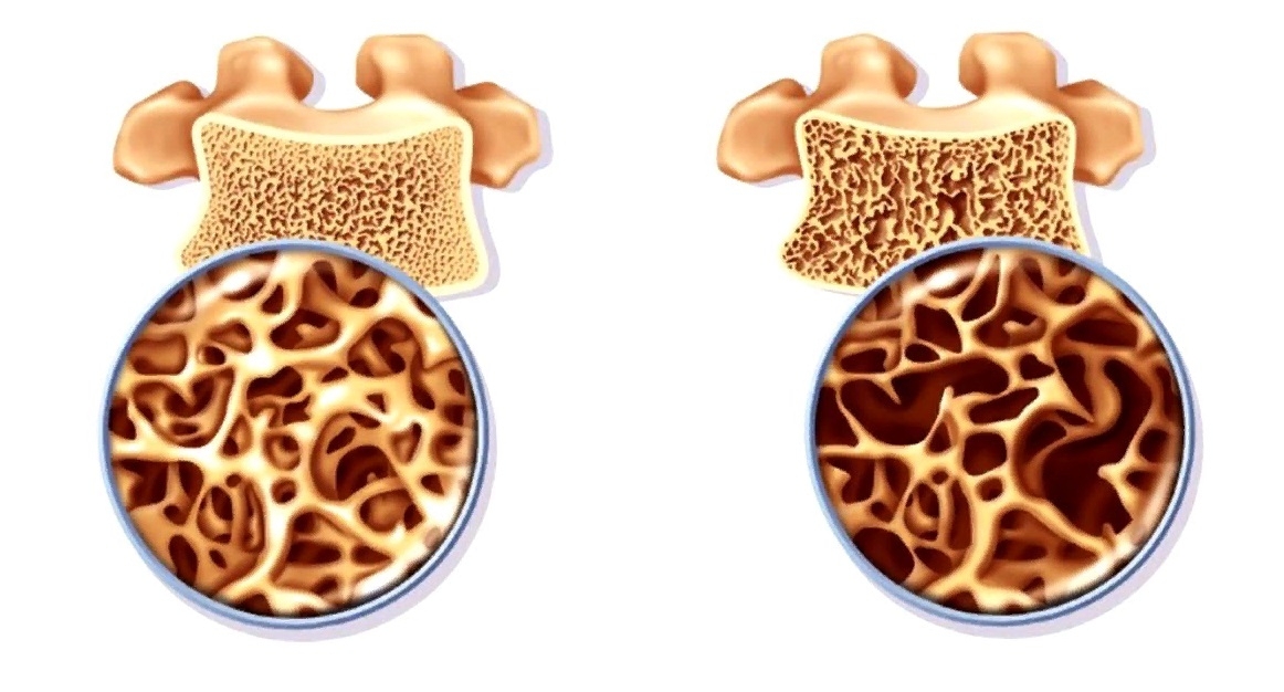 Остеопороз позвоночника – симптомы
