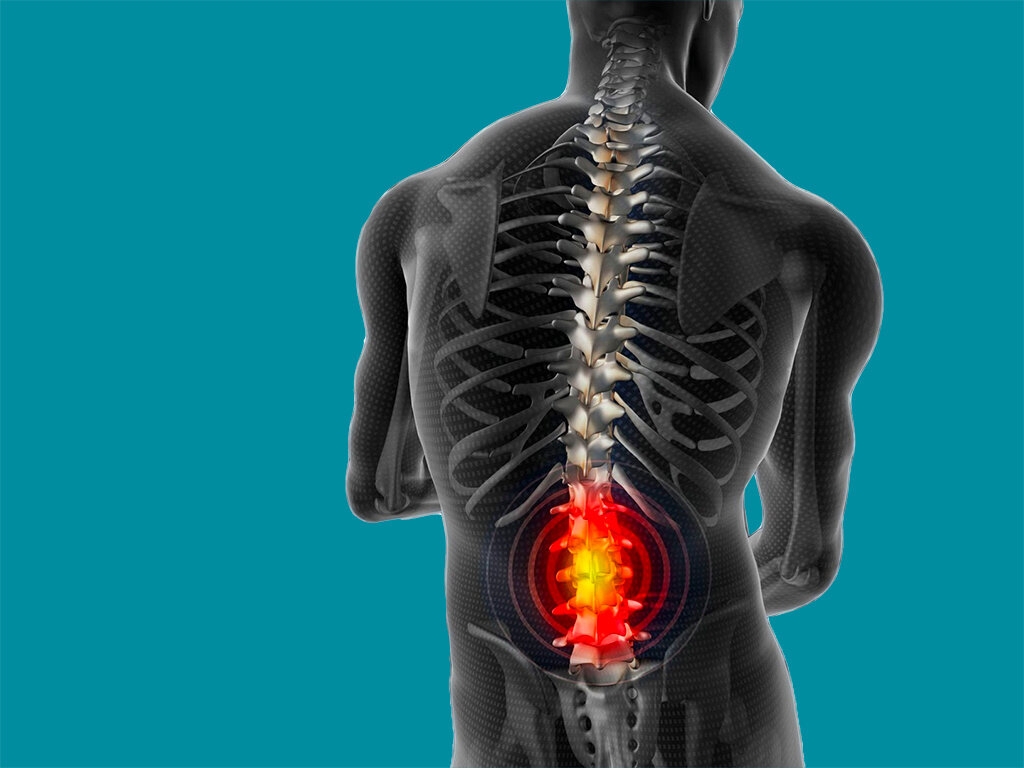 Корсет при поясничной грыже