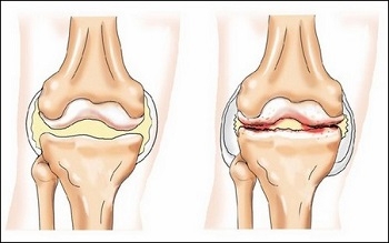 Типы наколенников