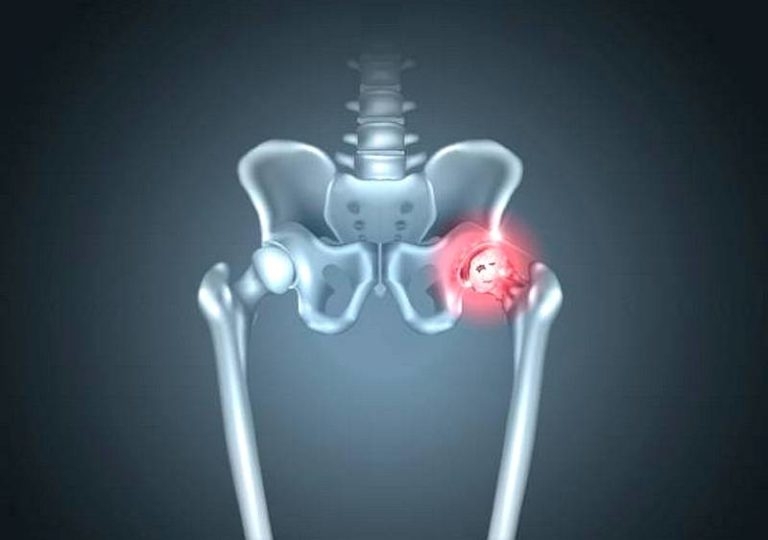 Остеоартроз тазобедренного сустава