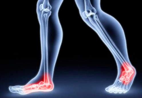 Комбинированное плоскостопие