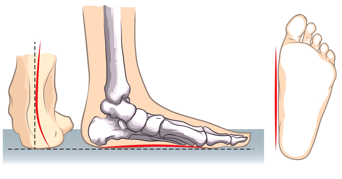 Продольное плоскостопие