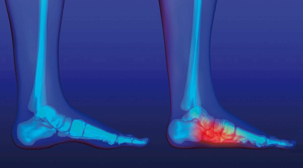 Симптомы и причины плоскостопия