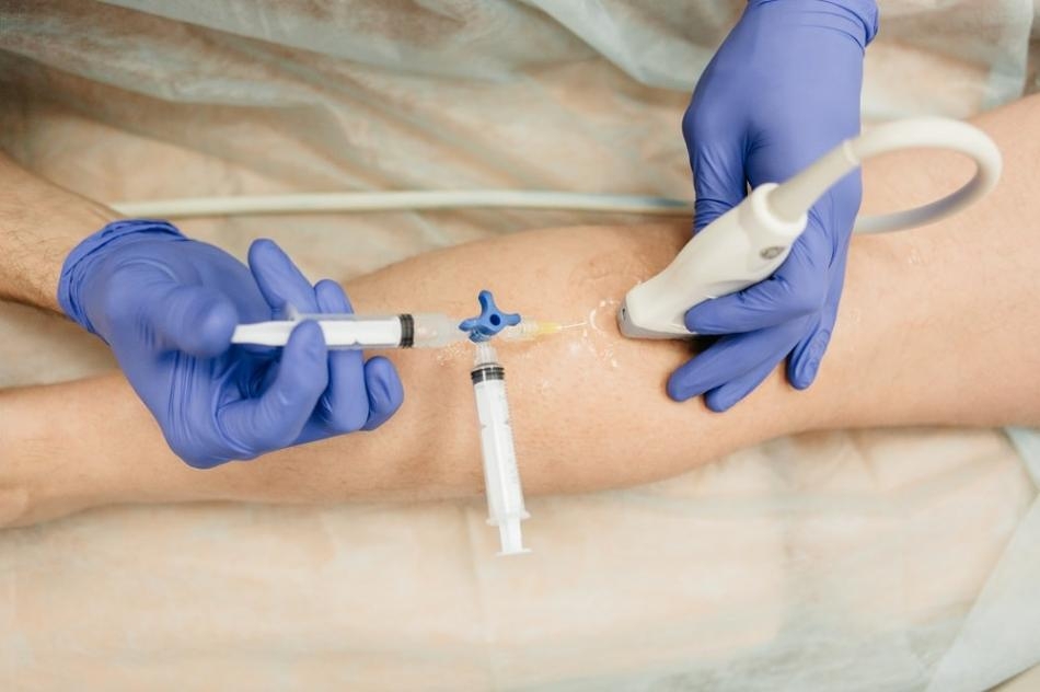 Метод склеротерапии