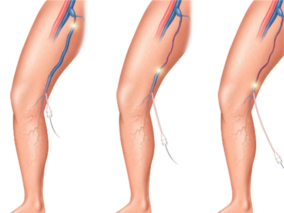 Хирургическое лечение варикозной болезни вен на ногах