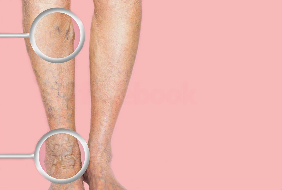 Метод консервативного лечения варикозной болезни